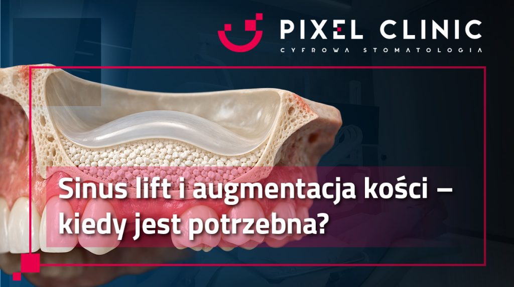 Sinus lift i augmentacja kości – kiedy jest potrzebna?
